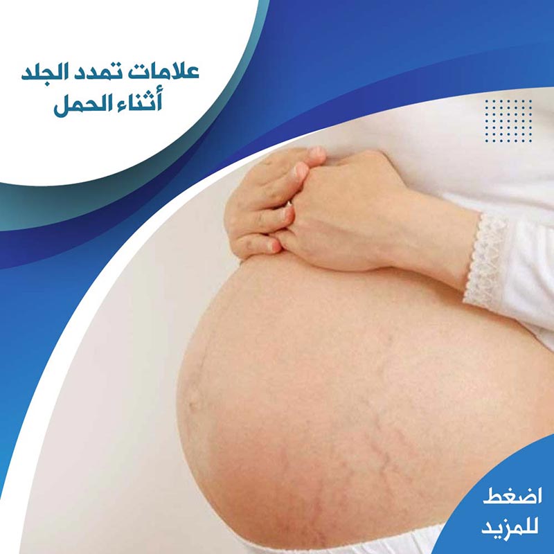 علامات تمدد الجلد أثناء الحمل - صيدلية لايف كير